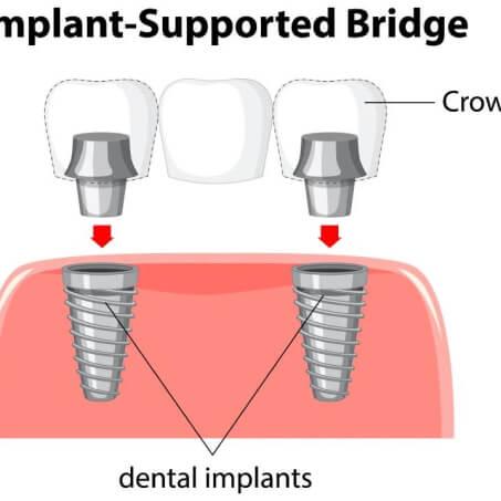 Implant Tedavisi 4