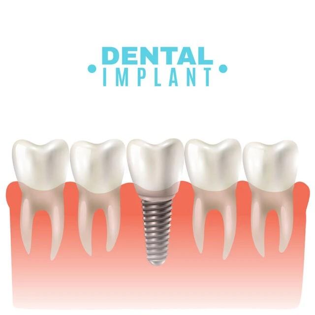 What is Same-Day Implant Treatment?