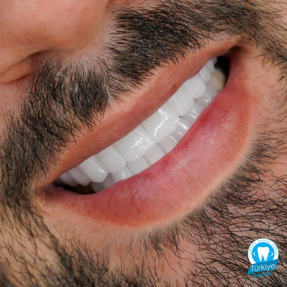 Zirkonyum Kaplama | Türkiye Dental