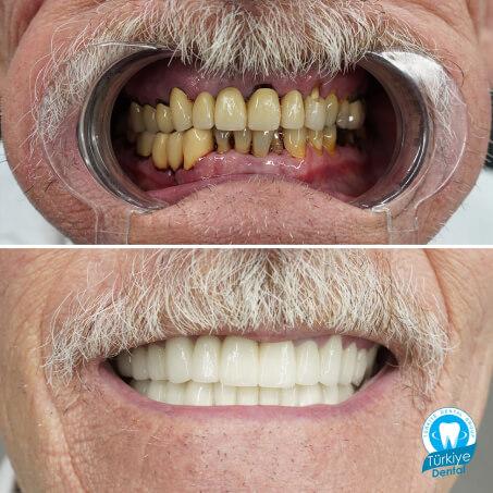 Zirkonyum Kaplama | Türkiye Dental